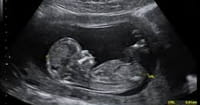 South Dakota's Gov. Signs Fourth Pro-Life Measure, Mandating Full Disclosure of Facts to Women Seeking Abortions