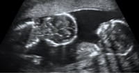 Two Priests Share How Their Mother Rejected Doctor’s Advice to Abort
