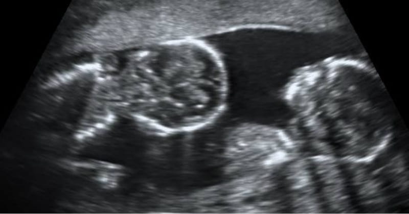 Ultrasound for twins