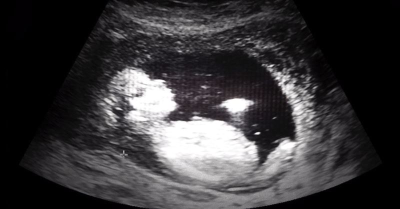 StemExpress CEO Admits to Trafficking Baby Body Parts, Including Intact Heads, Beating Hearts