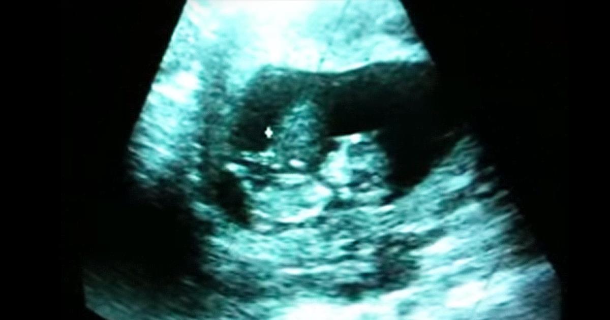 Baby ‘Gymnast’ Plays Around During Ultrasound - Cute Videos