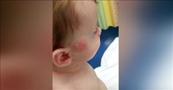 Kristen Milhone, a mother in Michigan, set her 7-month-old son down for his usual nap one Wednesday morning. But when Jack awoke, she pulled him out of the bassinet a noticed a mark on the side of his face. "There was these blisters that were yellow and just starting to form ... It just reminded me of a chemical burn so I kind of freaked out a little bit." That’s when Kristen decided to take Jack to the emergency room and get checked out. 

At first, the doctors were stumped as to what caused this bump on Jack’s face. But then, Kristen shared that she lets Jack sleep with his pacifier. The diameter of the mark was very similar in size to the Jack’s pacifiers. The doctors came to the conclusion that the pacifier must’ve suctioned to Jack’s face while he slept and caused the blistery mark. 

This particular pacifier is a common brand that is sent home from the hospital with new moms. “You put your kids [to bed] thinking they are safe and these things you really might trust turn out to be dangerous,” said Kristen. 

Now, Kristen is sharing her story in hopes that other mothers will think twice before letting their child sleep with a pacifier. “If you are going to use it, take it away from them as soon as they fall asleep. Especially when they start rolling around, don’t let them sleep with it in the crib." This is a warning that all parents need to hear. 